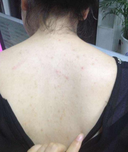 老中医:夏天到了女生后背&rdquo;疙瘩&ldquo;不漂亮,每天吃点&ldquo;它&rdquo;,多年疙瘩全扫光,马上见效